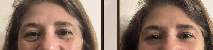A customer's under-eye area before use on the left and after use on the right.