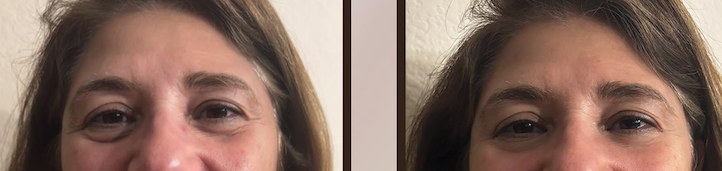 Before and after photos from a customer's under-eye area: visible puffiness on the left before using the device, noticeably reduced puffiness on the right after.